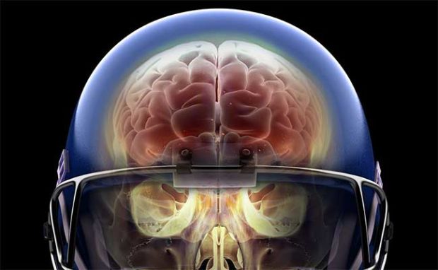 Athletes May Learn of Concussion Damages With Brain Scans