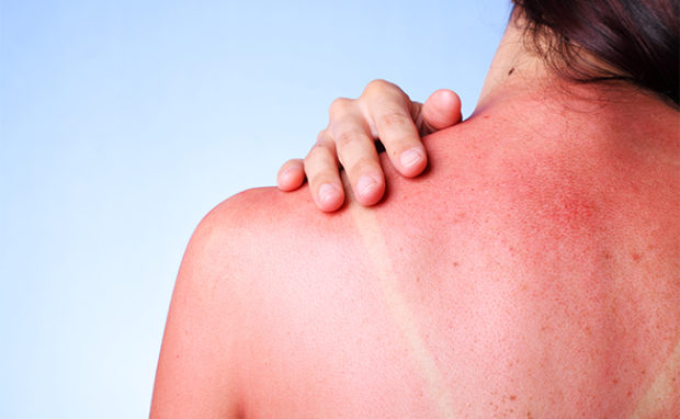 Effective ways to cure a Sunburn, FAST!