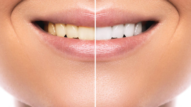 Best Teeth Whitening Method | Turn Your Beige Pearls into ...