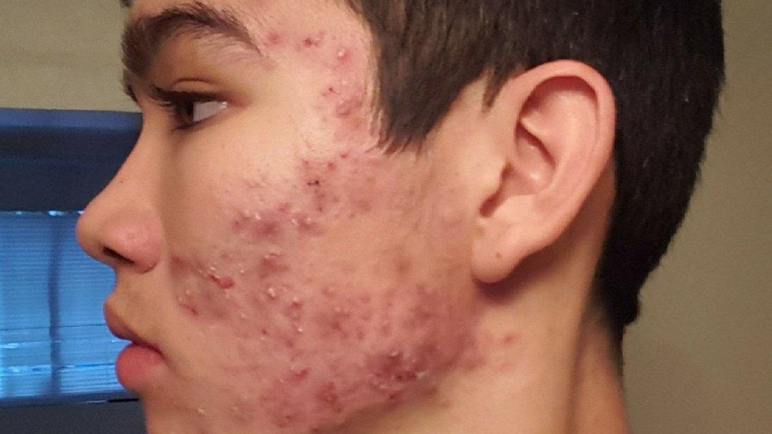 How To Get Rid Of Acne Fast Easy Stet By Step Solution