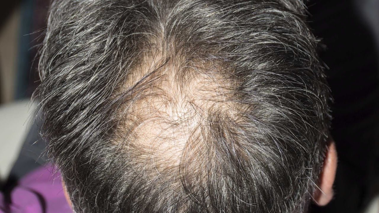 Сонник выпал волос на голове. Hair loss. Can stress cause hair loss.
