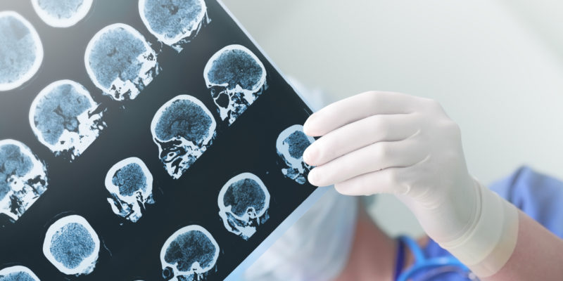 cbd oil for seizures