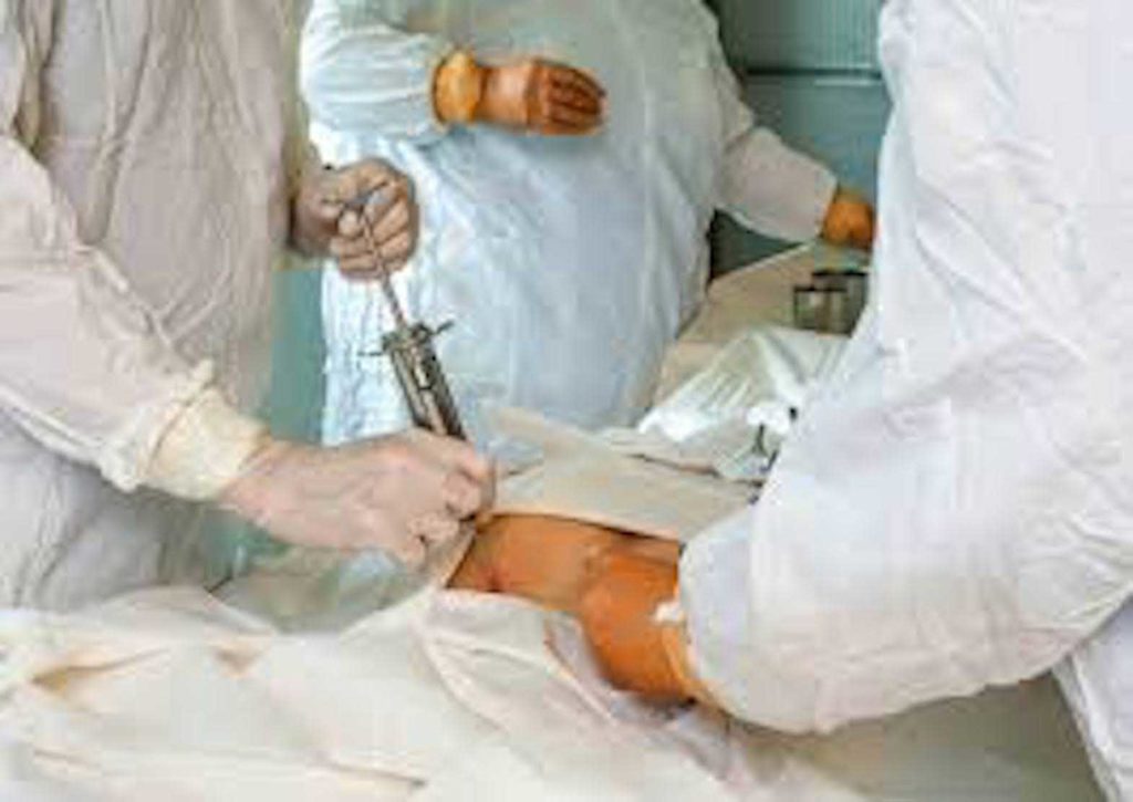 A stem cell transplant procedure.