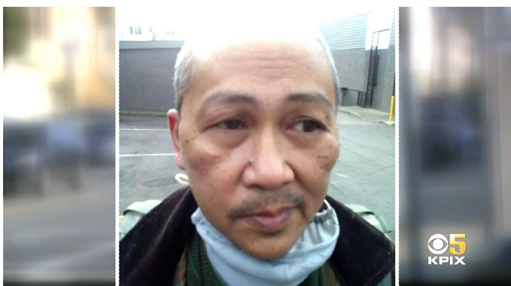 Ron Tuason, 56, shows facial injuries from anti-Asian attack. SCREENSHOT KPIX 5.