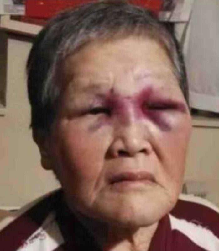 Xiao Zhen Xie suffered two blackeyes in an unprovoked attack. SCREENSHOT