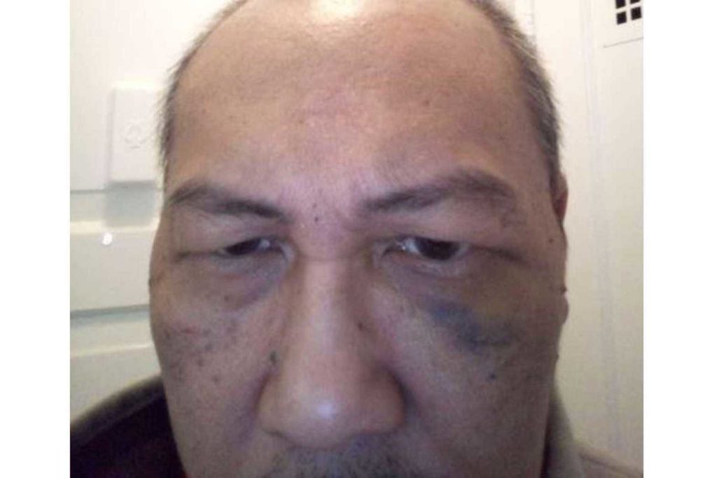 San Francisco resident Ron Tuason, 56, suffered a blackeye after he said he was attacked on March 13, 2021, by a suspect who shouted racist slurs. The suspect, Victor Brown, has been charged with felony assault and a hate crime. CONTRIBUTED