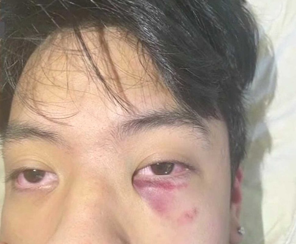 Photo of C.J. Enguillado's bruised face posted on TikTok. SCREENSHOT