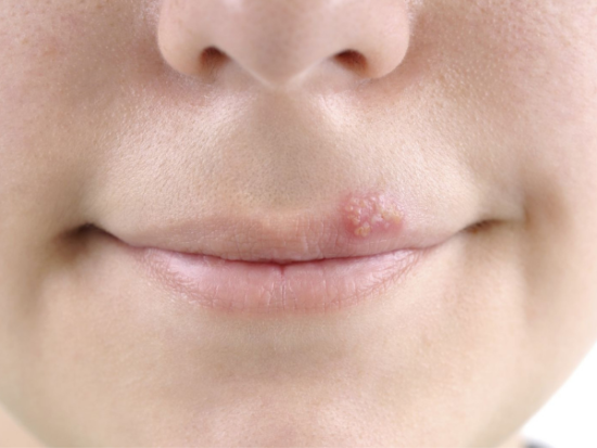 How do I get rid of a cold sore overnight?
