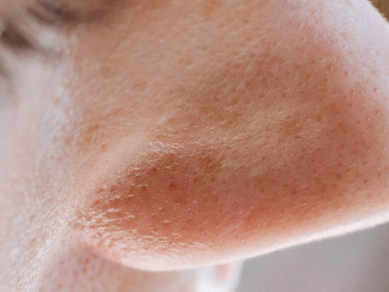 Avoid pore strips, pore needles, and other DIY extraction methods.
