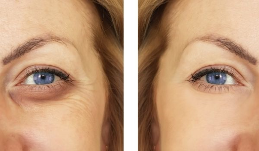 What Are Eyelid Lift Tapes?