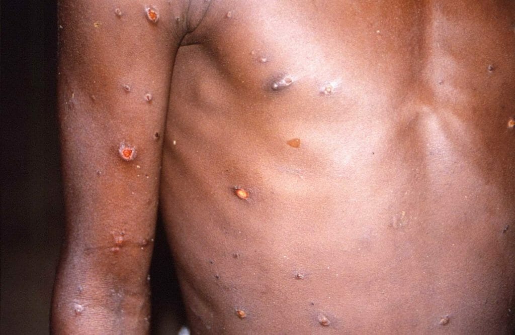 An image created during an investigation into an outbreak of monkeypox, which took place in the Democratic Republic of the Congo, 1996 to 1997, shows the arms and torso of a patient with skin lesions due to monkeypox. REUTERS