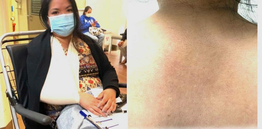 Juslyn Manalo released photos on social media of herself with her arm in a sling and of bruising on her back. TWITTER