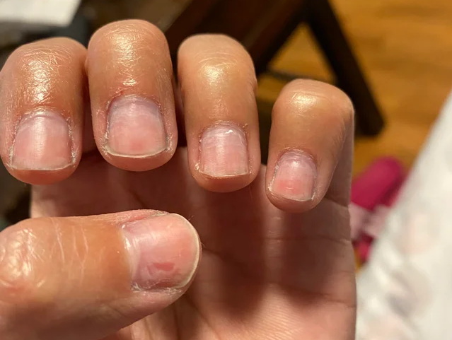 Nail Damage Caused By Removal