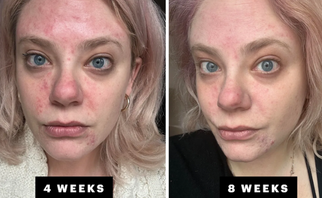 Spironolactone Before and After Real Results from Users