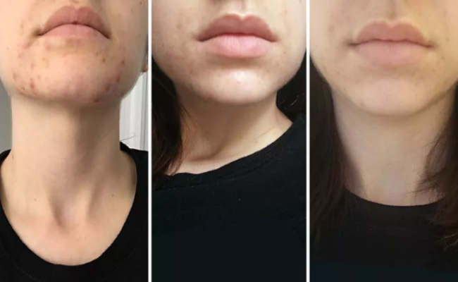 Spironolactone Before and After Real Results from Users