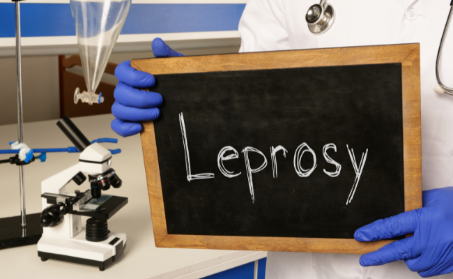 Central Florida accounts for 81 percent of leprosy cases