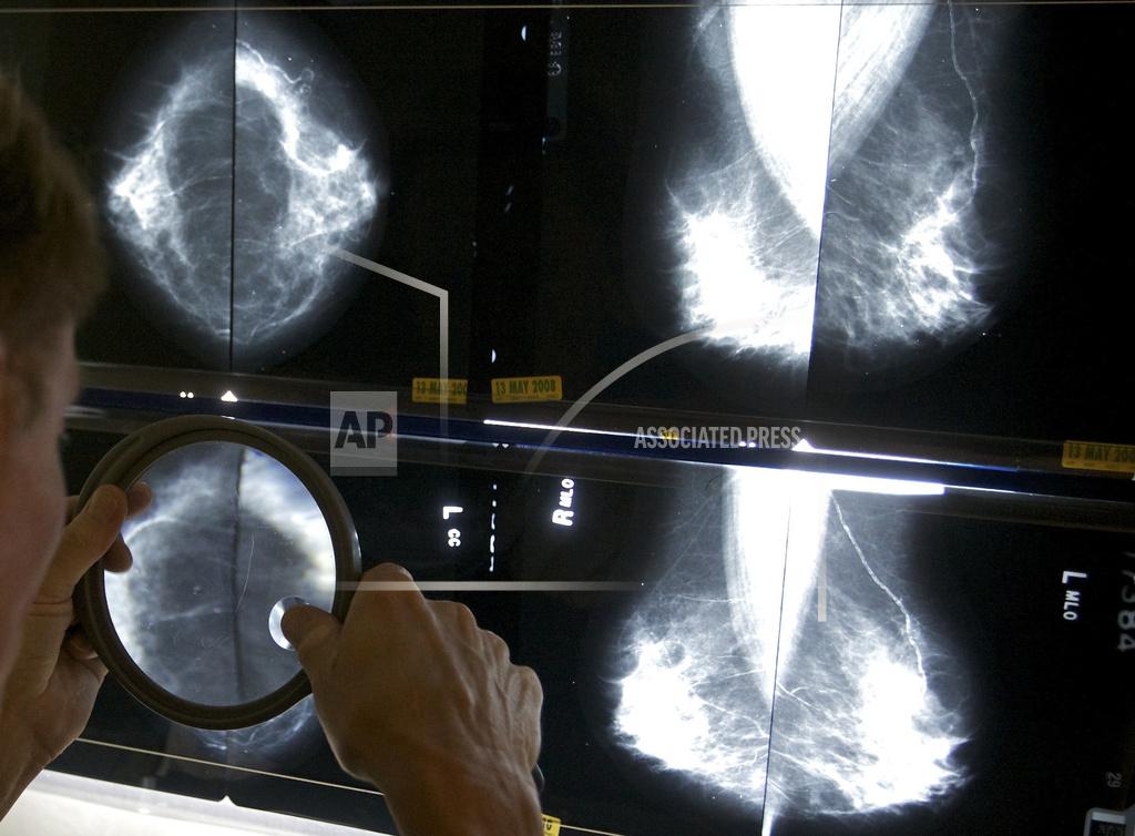 Mammograms should start at 40 to address rising breast cancer rates