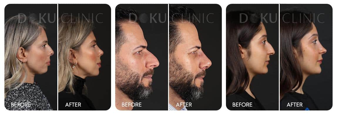 Rhinoplasty in Türkiye: A Spotlight on Dr. Engin Öcal