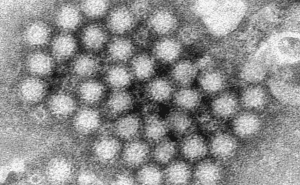 Norovirus is back in full force with US cases of the stomach virus surging