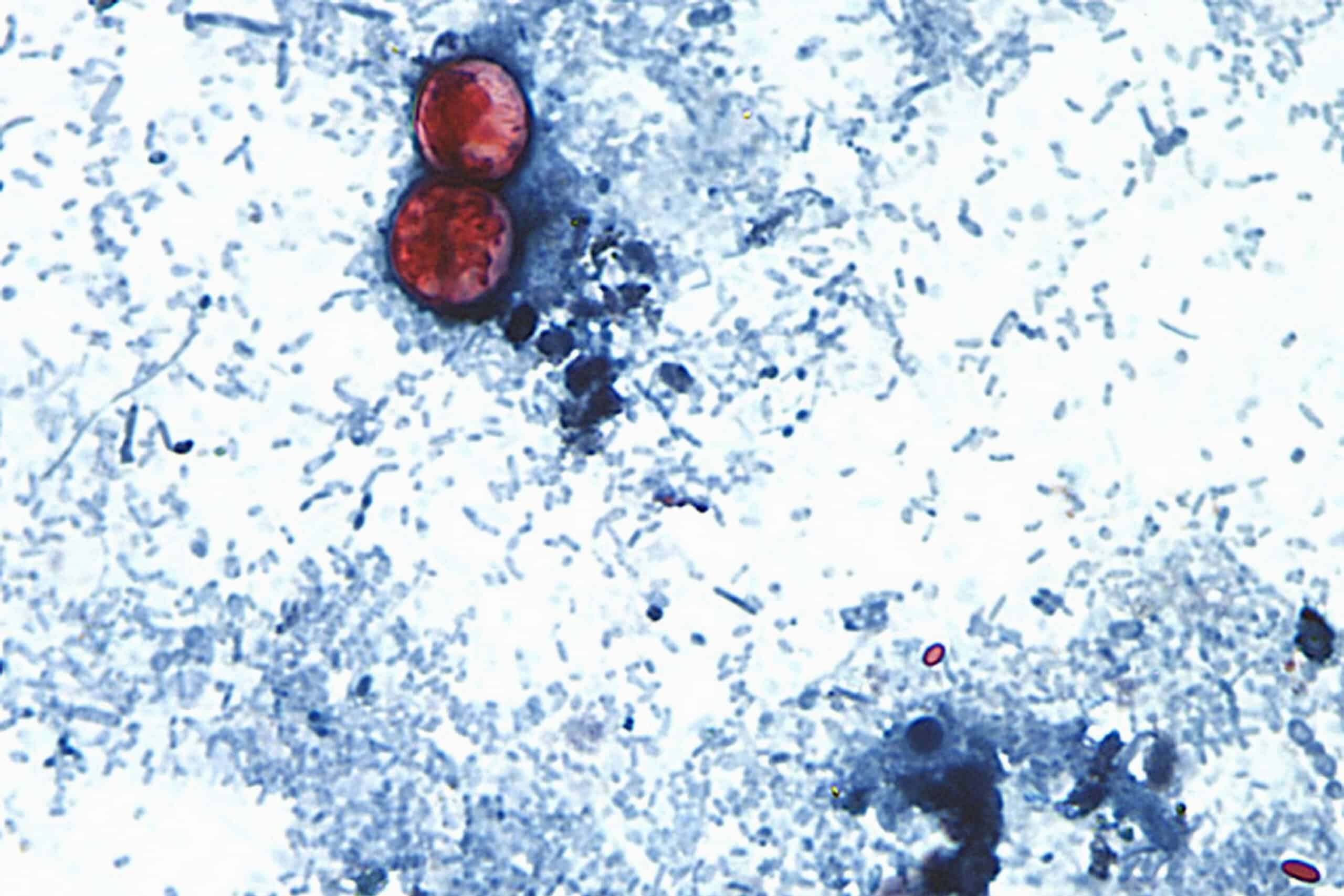 Cyclospora Outbreak